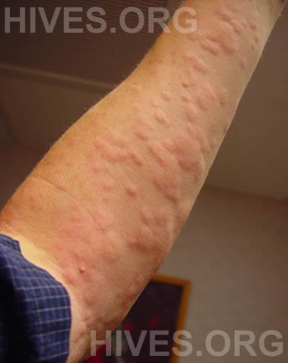 hives on arms - pictures, photos