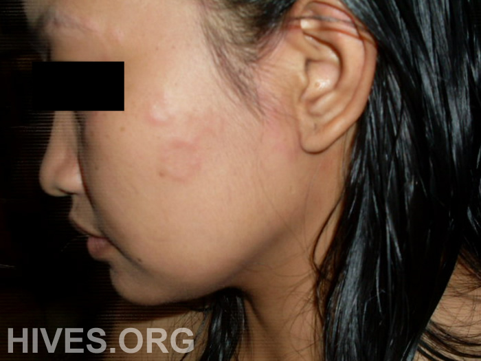 Facial Hives