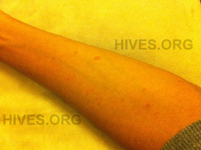 Hives: MedlinePlus Medical Encyclopedia