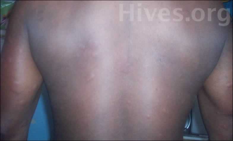 Back Hives