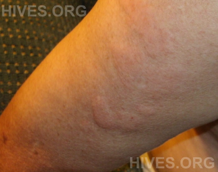 pictures of hives on legs