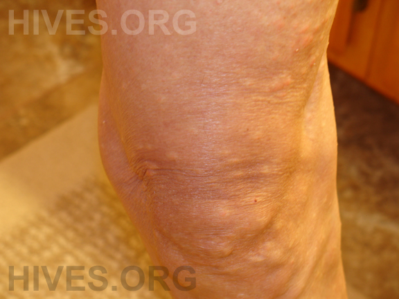 hives on hands and feet