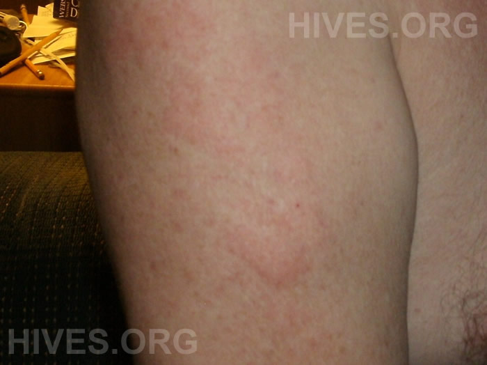 hives on arms