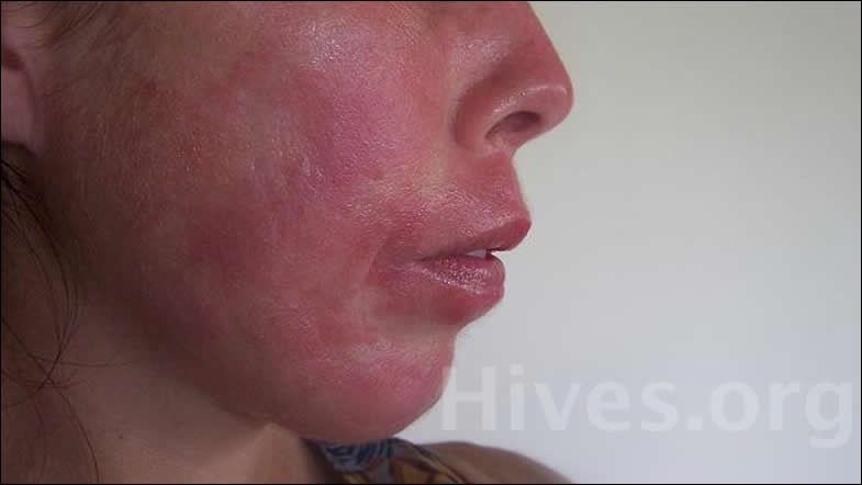 Facial Hives