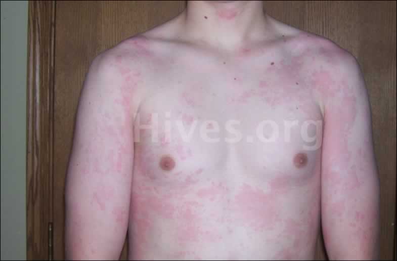 Where do you find pictures to help diagnose a rash on arms and shoulders?