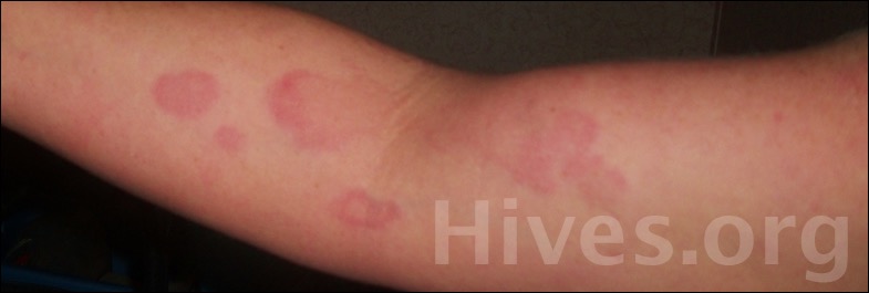 Where do you find pictures to help diagnose a rash on arms and shoulders?