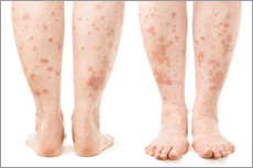 Hives Pictures