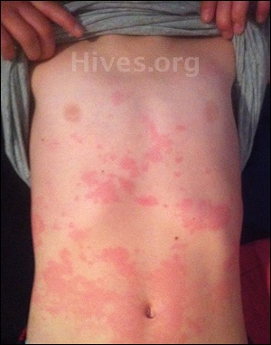 Are Hives Contagious?