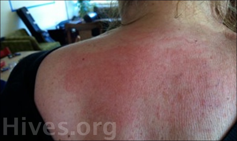 Hives From Stress