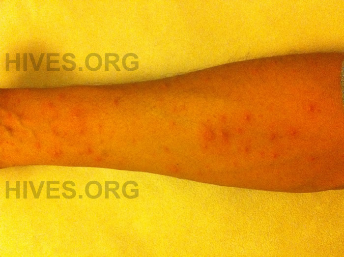 picture of hives on arm