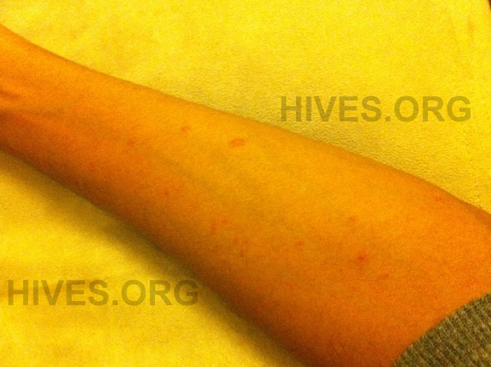hives on arms picture