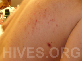 hives on back