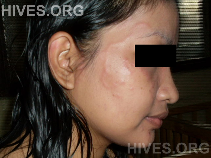 hives on face picture