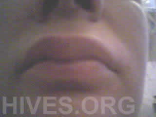 hives on lips