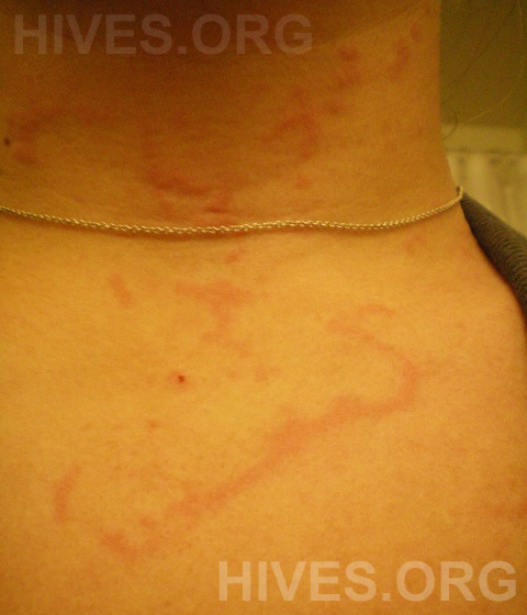 hives on neck