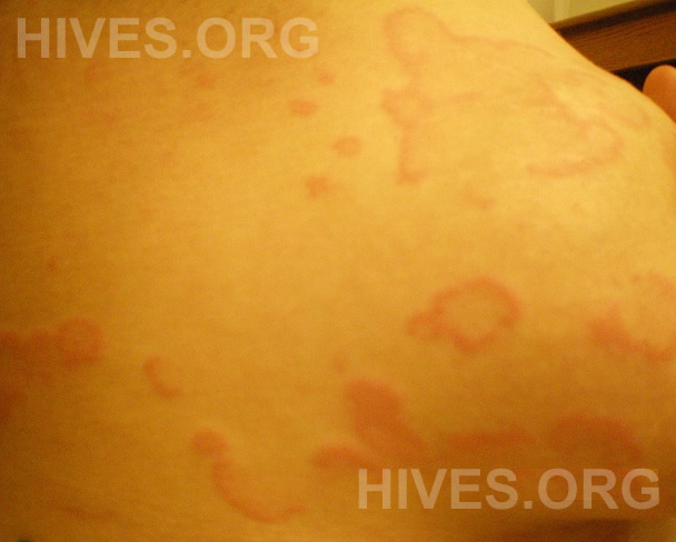 hives on shoulder