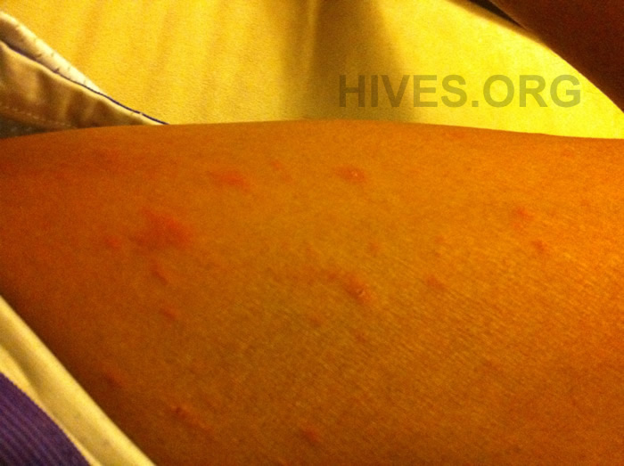 picture of hives on thigh