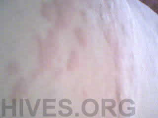 hives on back