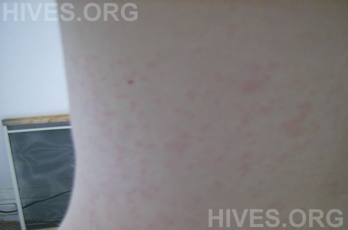 picture of back hives