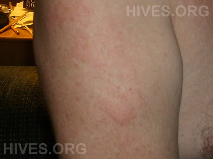 picture of hives on arm