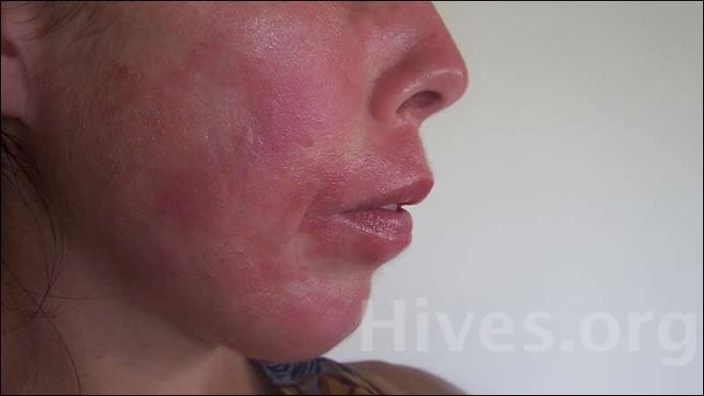 what allergies cause hives on face