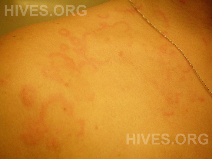 shoulder hives